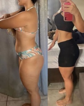 Antes e depois — paciente 4